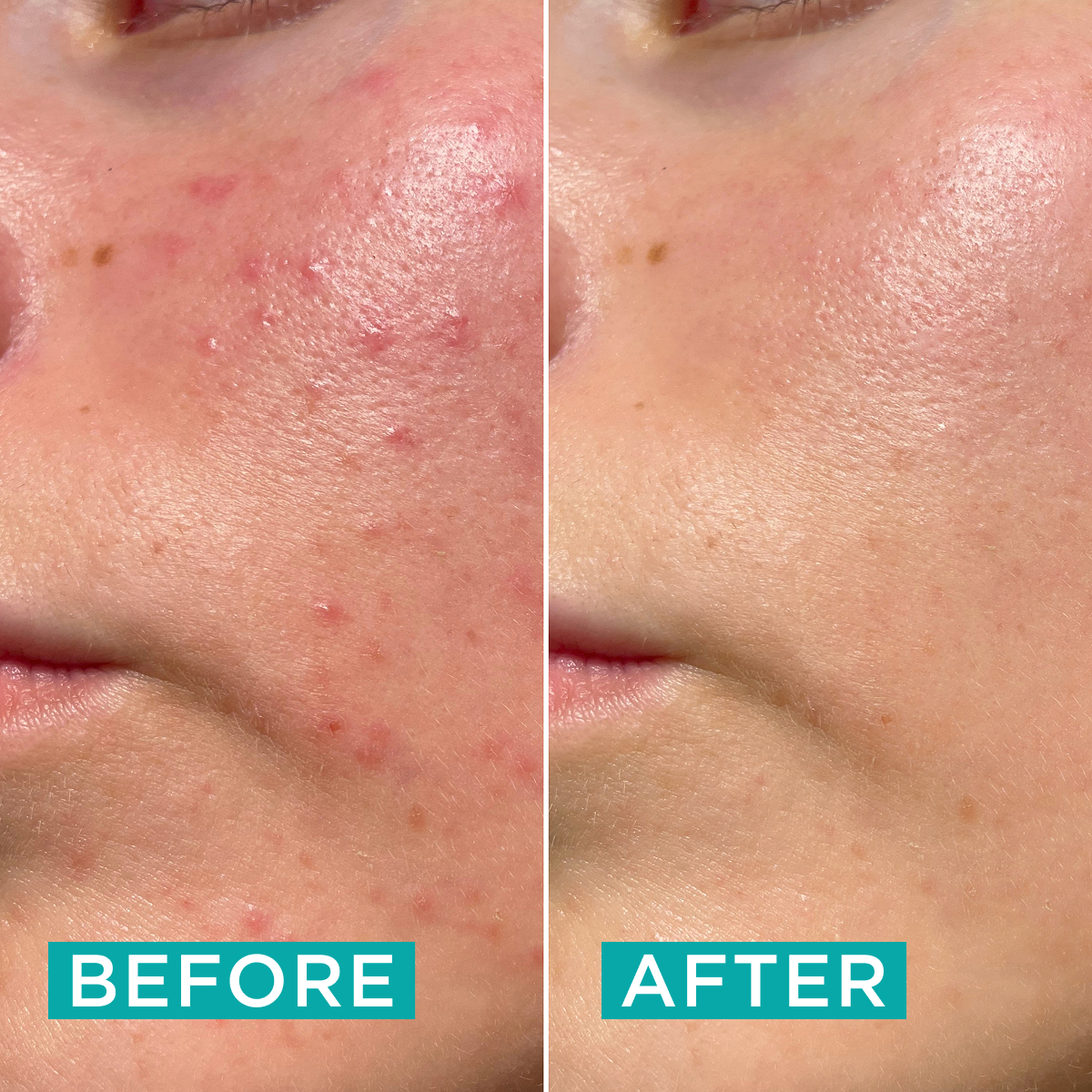 Clear Skin Spot Treat & Cover